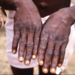 mpox