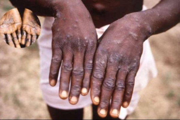 mpox