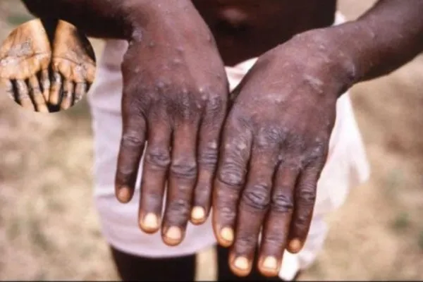 mpox