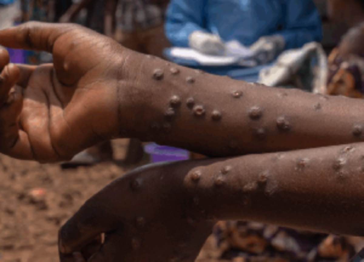 Ghana Records 12 New Mpox Cases as Total Confirmed Infections Rise to 980