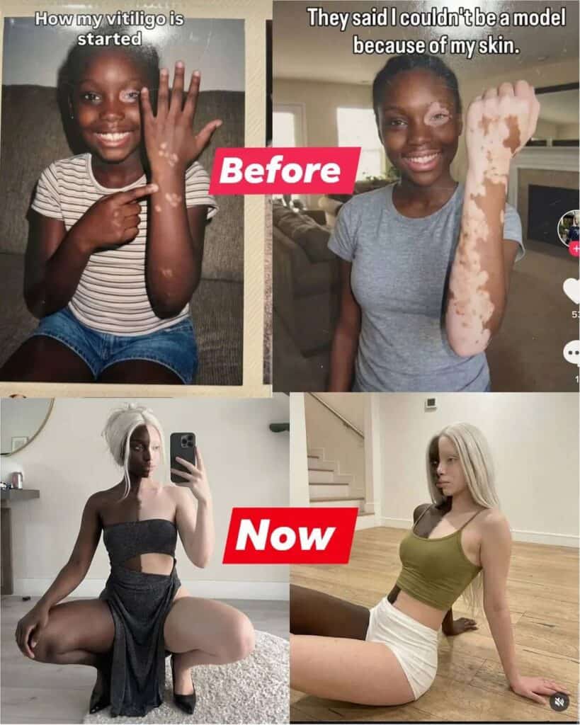 vitiligo lady skin