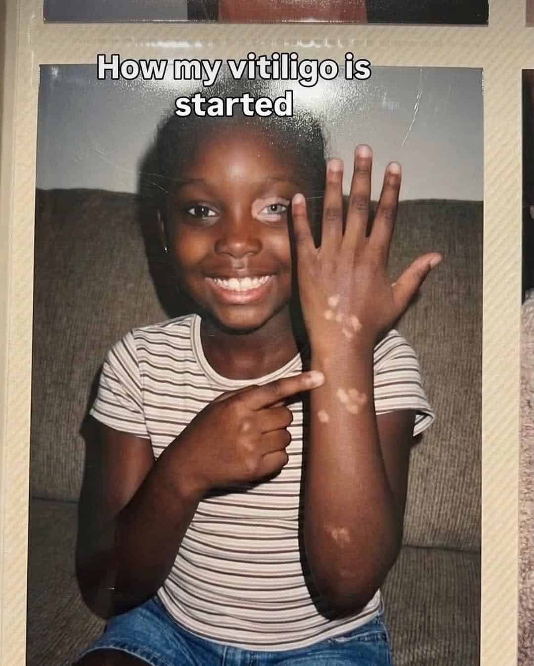 vitiligo skin