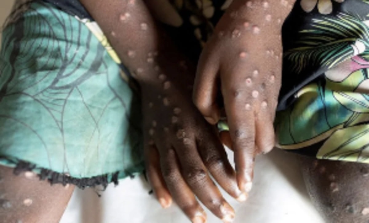Ghana Mpox Cases Rise Again as Total Approaches 1,000