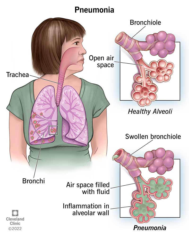 Why are Children in Ghana Still Dying from Pneumonia Experts Warn of Vaccination Gaps Ahead of World Immunization Week (April 24-30)