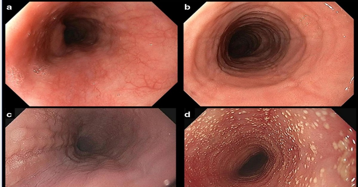 Study Links I-SEE Scores With Esophageal Function in Eosinophilic Esophagitis