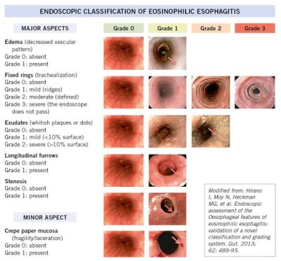 Study Links I-SEE Scores With Esophageal Function in Eosinophilic Esophagitis