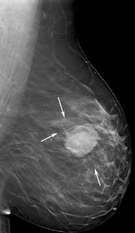 Breast